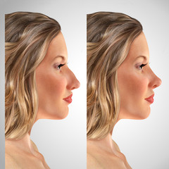 comparative portrait of a 3d young woman before and after rhinoplasty