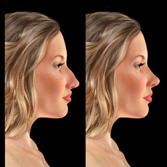 comparative portrait of a 3d young woman before and after rhinoplasty