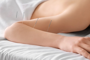 Young woman undergoing acupuncture treatment, closeup - obrazy, fototapety, plakaty