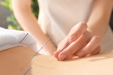 Obraz na płótnie Canvas Young woman undergoing acupuncture treatment, closeup