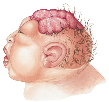 Anencephaly is the absence of a large part of the brain and the skull. Anencephaly occurs early in the development of an unborn baby. It results when the upper part of the neural tube fails to close.