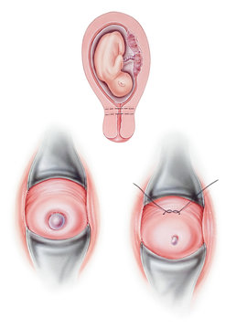 Cervical Cerclage, A Surgery Used To Keep An Incompetent Cervix Closed During Pregnancy.