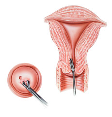 Biopsy of the cervix and endocervix.