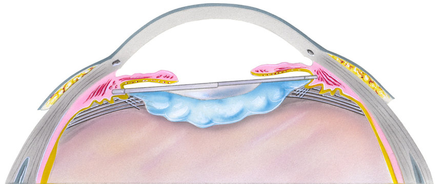 Step 6 of 7. A cataract is an eye disease in which the normally clear lens of the eye becomes cloudy or opaque, causing a decrease in vision.