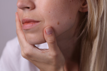 Obraz premium Checking benign moles : Beautifull Woman with birthmarks on face. Laser skin tags removal