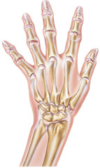 Shown is a hand with moderate arthritis of some of the joints, This would cause joint stiffness and pain as well as a reduction in range of motion.