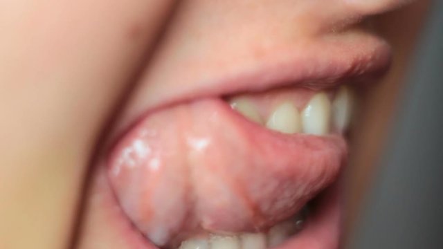 Girl goes with tongue over the wound after tooth extraction