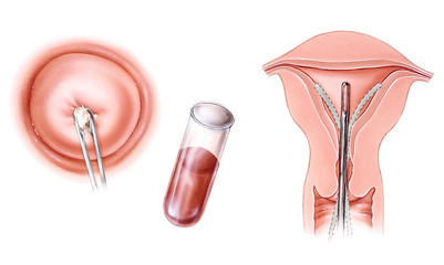 Pregnancy - Infertitlity Tests. Postcoital test (left), blood hormone test (middle), and endometrial biopsy (right).