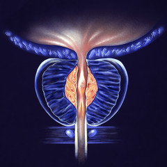 Prostate Gland - (BPH) Benign Prostatic Hyperplasia, Stage 1 - false color to highlight details.. - obrazy, fototapety, plakaty