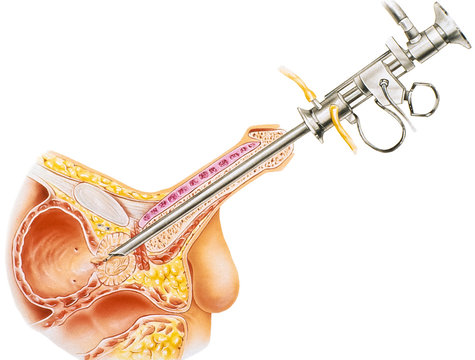 Prostate - Transurethral Resection Procedure of the prostate (TURP): 