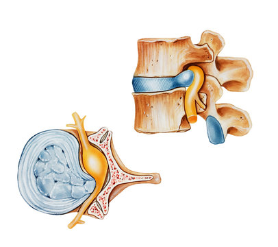 A herniated (slipped or ruptured) disc, side (top) and top (left) views. Shown is a ruptured.disc with the nucleus coming out of the annulus