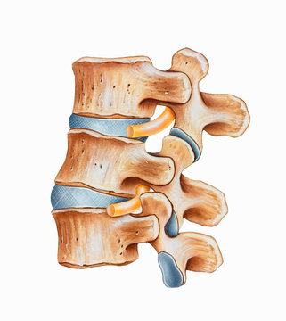 Spine - Lumbar Hyperlordosis is an exaggerated curvature of the lumbar spine most often involving the L3, L4, and L5 vertebrae.
