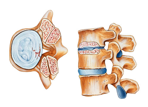 Spinal stenosis. The top view (left) shows the superior articular process of the inferior vertebra, the inferior articular process of the superior vertebra, and the narrowed spinal canal.