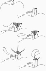 Surgery - Anomalous Coronary Artery Repair Technique. Sewing two anomalous coronary arteries together like a pair of pants to create one viable artery.