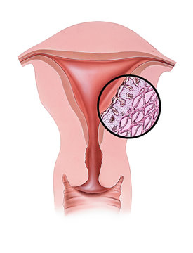 Conceptual illustration of dysmenorrhea (menstrual pain).