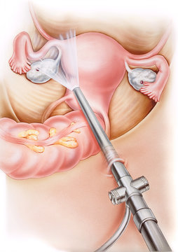 Uterus - Laparoscopy, in which a small incision is made in the abdomen and the laparoscope is inserted to view internal female organs. The ovaries, fallopian tubes, uterus, and colon are shown.
