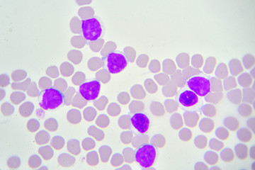 Leukemia cells in blood smear
