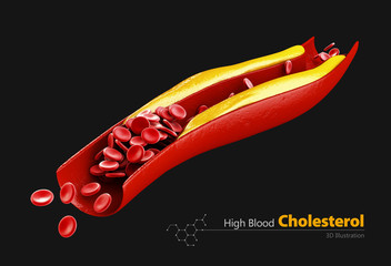 Cholesterol plaque in artery, 3d illustration. isolated black