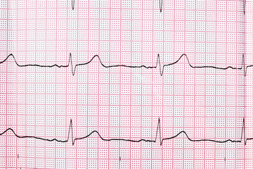 Close up of an electrocardiogram in paper form