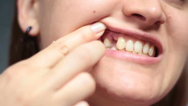 Girl pointing with fingers wound after tooth extraction