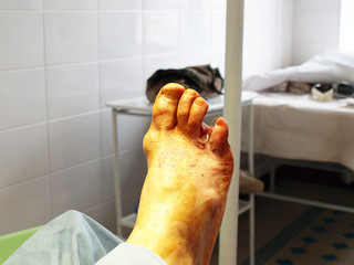 diabetic foot syndrome. operating. amputation of the fourth toe. - obrazy, fototapety, plakaty