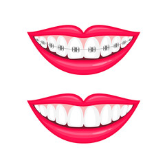 Fototapeta premium Perfect teeth before and after braces. Vector illustration isolated on white background. Dental care concept.