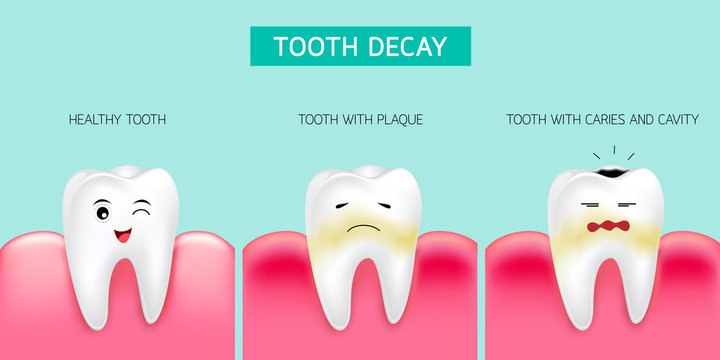 Step of tooth decay formation. Healthy tooth, forming dental plaque and finally caries and cavity. Cute cartoon design, illustration isolated on green background. Dental care concept.