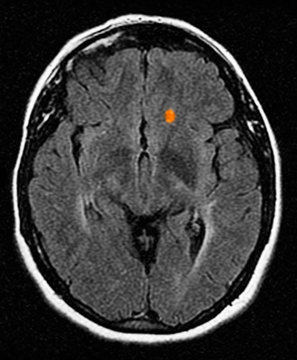 MRI of multiple sclerosis in a 42 year old woman