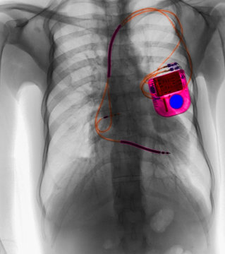 CXR with pacemaker for atrial fibrillation