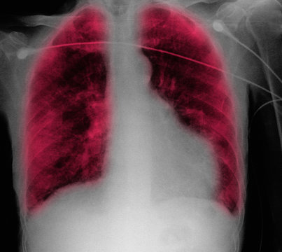 CXR of old man, congestive heart failure, anemia