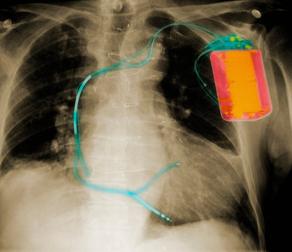 X-ray of chest with defibrillator