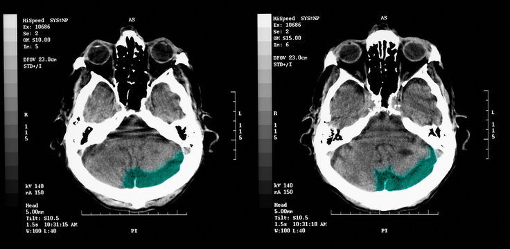 CT scan of elderly man with old occipital infarct