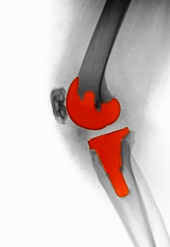 knee replacement in a 61 year old female