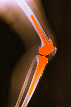 X-ray, total knee replacement