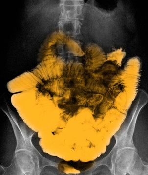 normal small bowel barium contrast abdominal X-ray