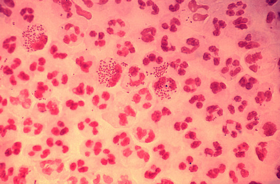 Photomicrograph of gonococcal urethritis