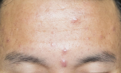Obraz premium Acne head on the forehead.