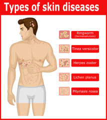 Types of skin diseases