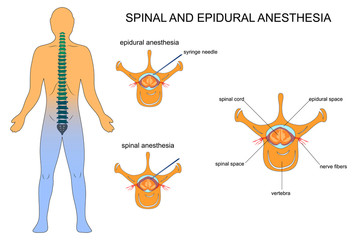 epidural and spinal anaesthesia - obrazy, fototapety, plakaty