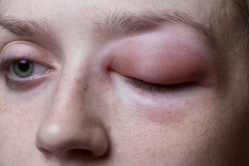 Young woman with allergic reaction - obrazy, fototapety, plakaty
