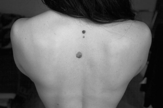 Moles On Back Of Woman, Black And White Colors