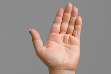 Female hand with dermatitis on gray background