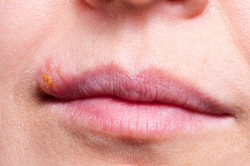 Herpes on the lip close up macro