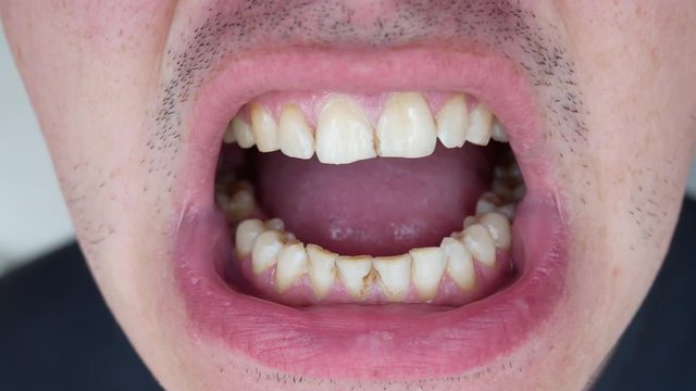The Man Opens the Mouth and Shows the Smoker's Teeth with Caries and Dental Stones