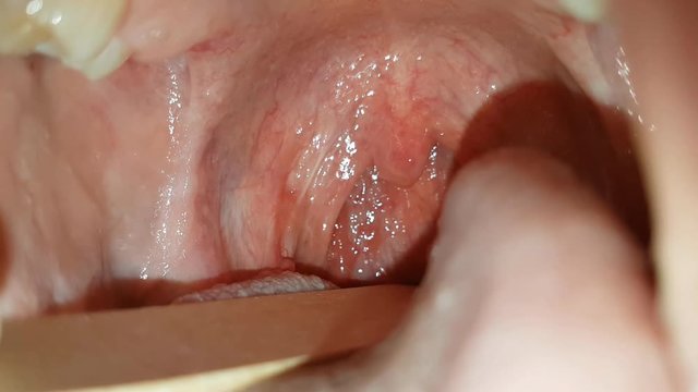 cavo orale femminile a seguito di intervento di tonsillectomia