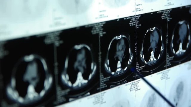 doctor study Breast pet-ct scan,medical x-ray.	