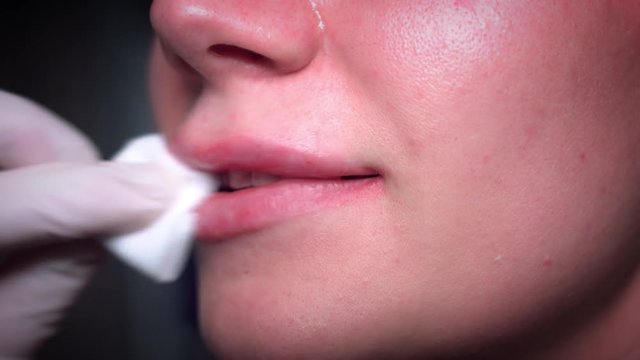 4K Close-up Woman Lips with Hyaluronic Acid Filler