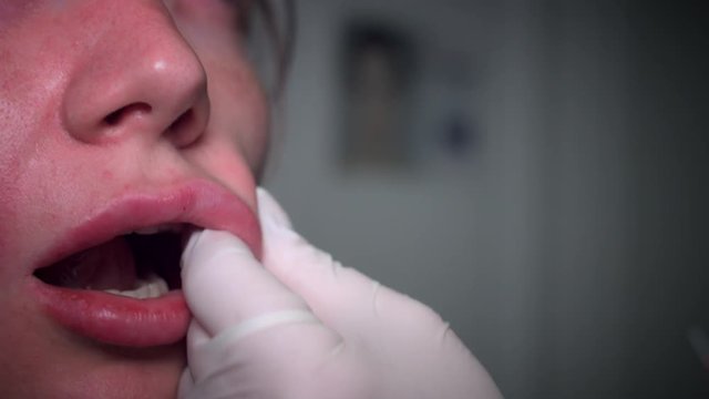 4K Close-up of Nasolabial filler Procedure
