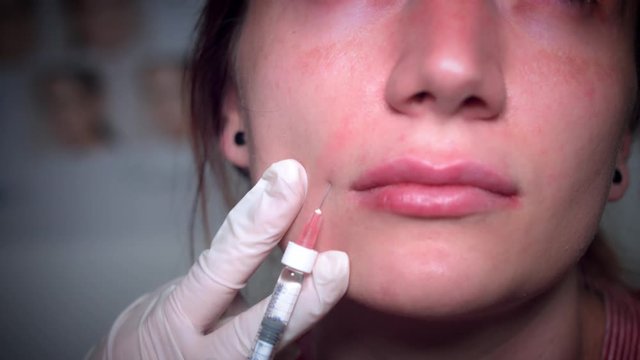 4K Doctor Applying Nasolabial Filler, close-up