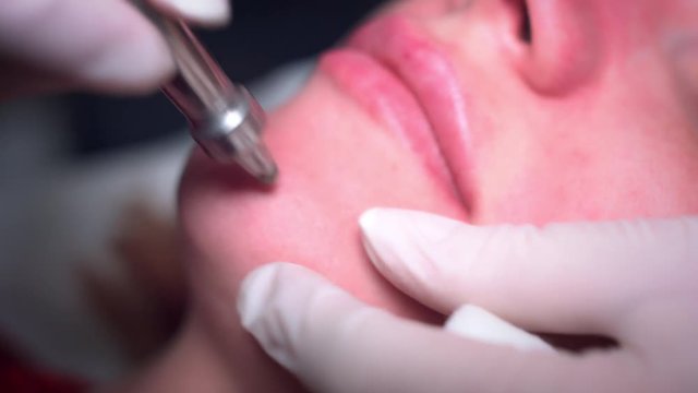 4K Woman Face with Microdermabrasion on Chin
